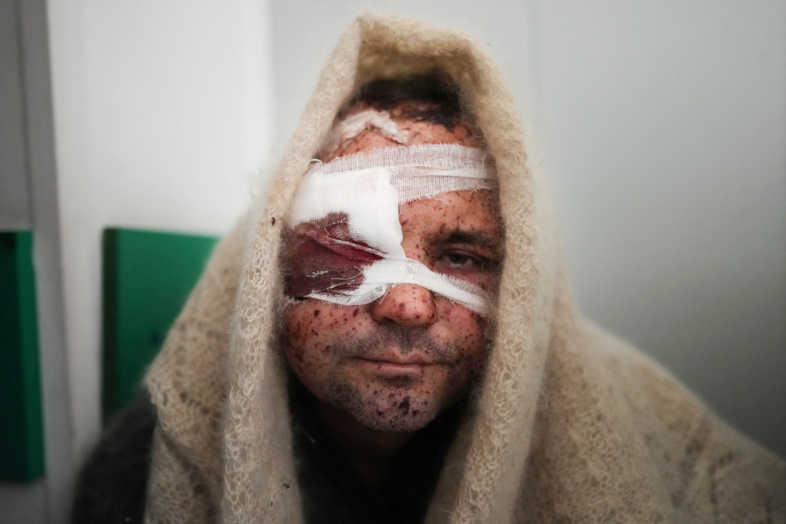 Serhiy Kralya, 41, looks at the camera after undergoing surgery at a hospital in Mariupol, eastern Ukraine, on March 11, 2022. Kralya was injured during shelling by Russian forces. (© Evgeniy Maloletka/AP Images)